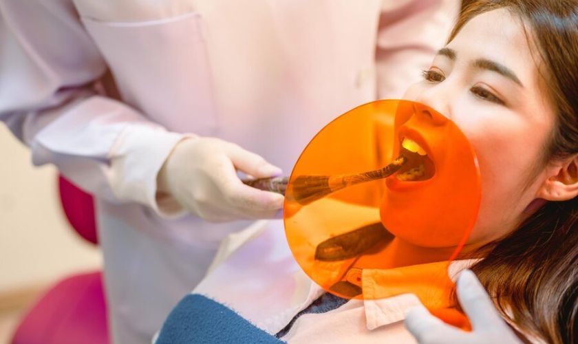 Tooth-Colored Composite Fillings